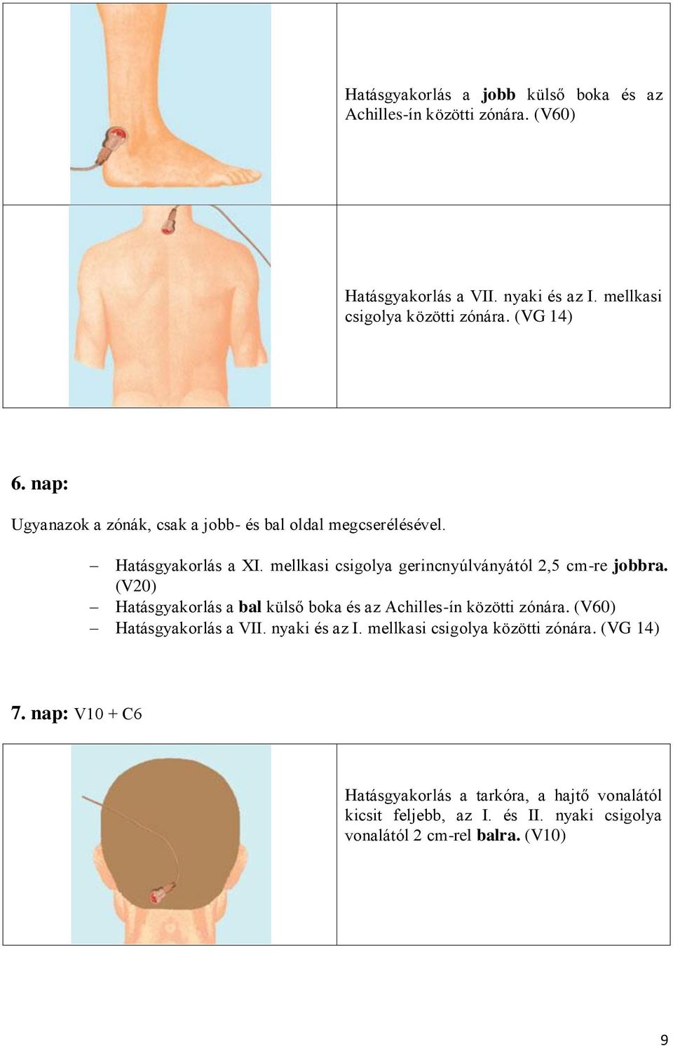 (V20) Hatásgyakorlás a bal külső boka és az Achilles-ín közötti zónára. (V60) Hatásgyakorlás a VII. nyaki és az I.