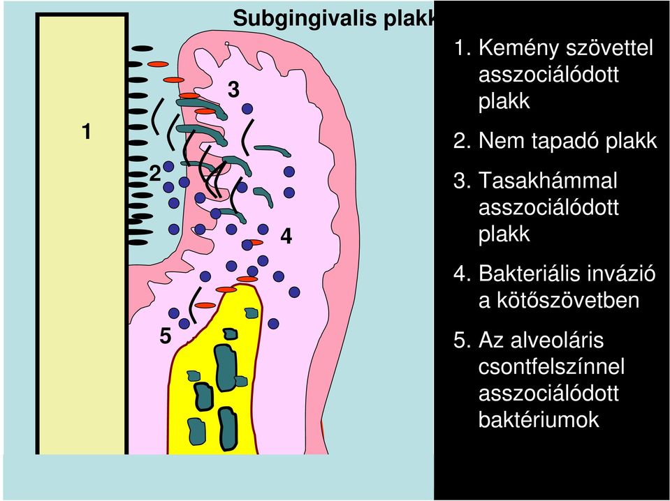 Nem tapadó plakk 3. Tasakhámmal asszociálódott plakk 4.