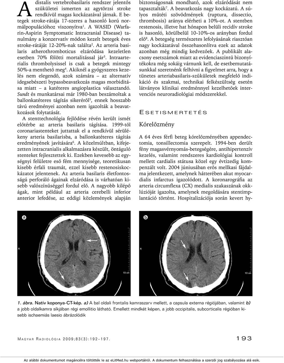 A WASID (Warfarin-Aspirin Symptomatic Intracranial Disease) tanulmány a konzervatív módon kezelt betegek éves stroke-rátáját 12-20%-nak találta 2.