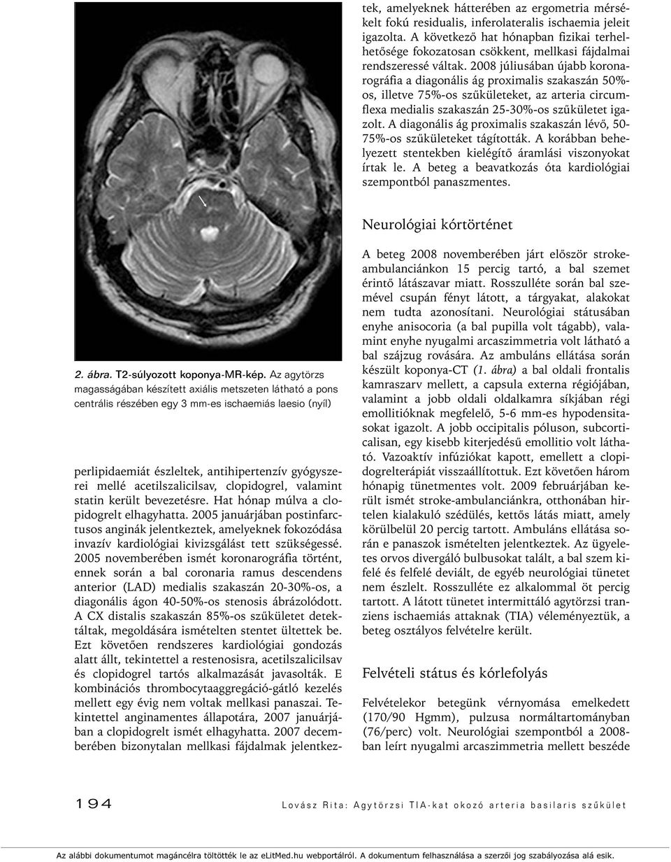 2008 júliusában újabb koronarográfia a diagonális ág proximalis szakaszán 50%- os, illetve 75%-os szûkületeket, az arteria circumflexa medialis szakaszán 25-30%-os szûkületet igazolt.