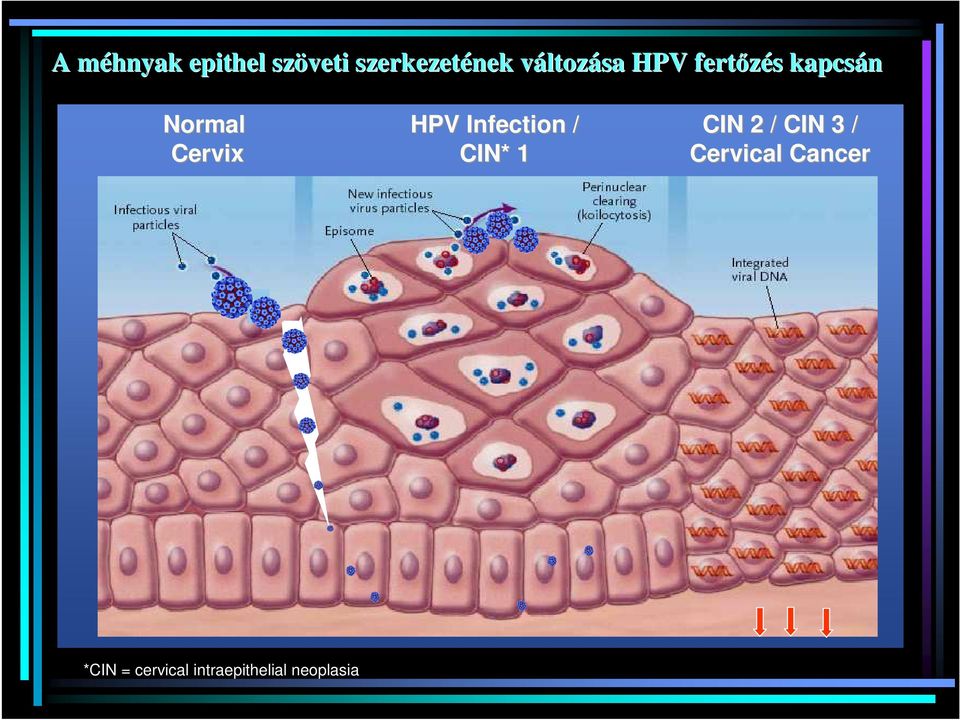 Cervix HPV Infection / CIN* 1 CIN 2 / CIN 3 /