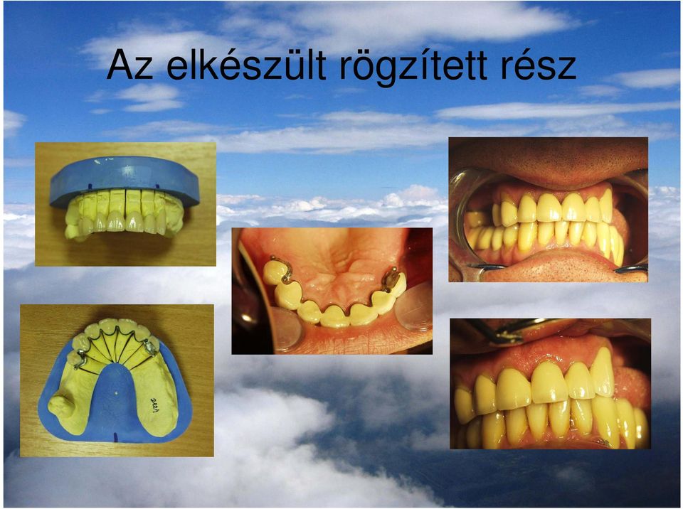 rögzített