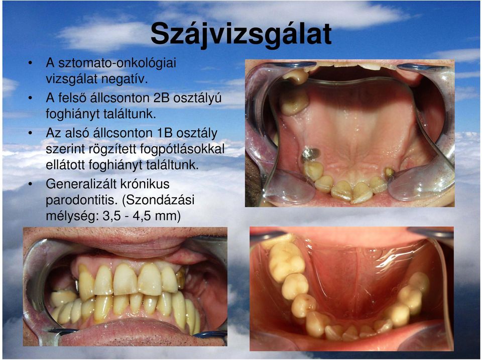 Az alsó állcsonton 1B osztály szerint rögzített fogpótlásokkal