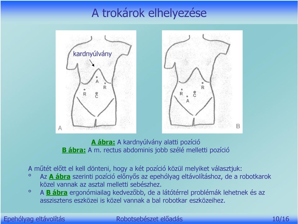 ábra szerinti pozíció előnyős az epehólyag eltávolításhoz, de a robotkarok közel vannak az asztal melletti sebészhez.