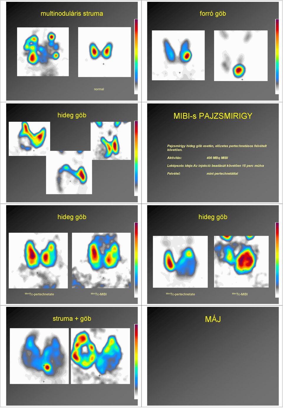 Aktivitás: 400 MBq MIBI Leképezés ideje:az injekció beadását követıen 15 perc múlva