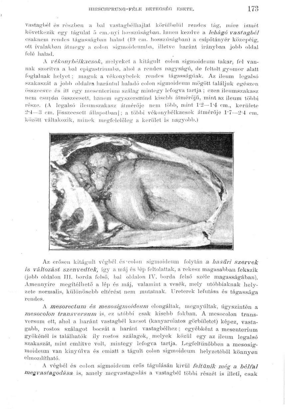 hosszúságban) a csípőtányér közepéig, ett ívalakban átmegy a colon sigmoidonmba, illetve Haránt irányban jobb oldal felé halad.