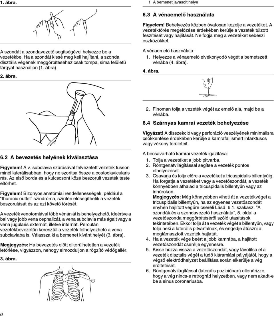 Ha a szondát kissé meg kell hajlítani, a szonda disztális végének meggörbítéséhez csak tompa, sima felületű tárgyat használjon (1. ábra). 2. ábra. A vénaemelő használata: 1.