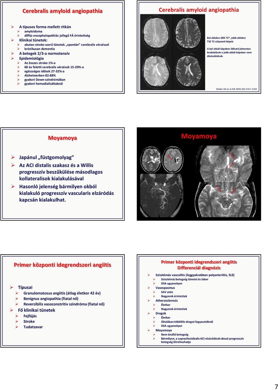 82-88% gyakori Down-szindrómában gyakori hemodializáltaknál Bal oldalon GRE T2*, jobb oldalon TSE T2 súlyozott képek: A bal oldali képeken látható jelmentes lerakódások a jobb oldali képeken nem
