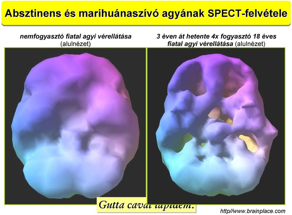 át hetente 4x fogyasztó 18 éves fiatal agyi vérellátása