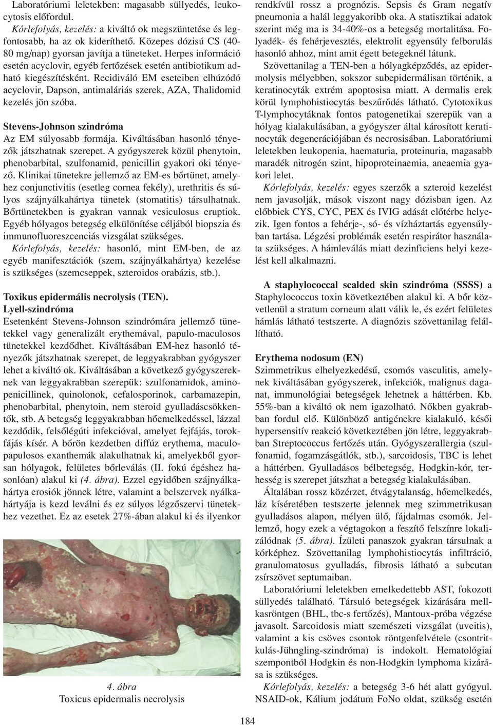 Recidiváló EM eseteiben elhúzódó acyclovir, Dapson, antimaláriás szerek, AZA, Thalidomid kezelés jön szóba. Stevens-Johnson szindróma Az EM súlyosabb formája.