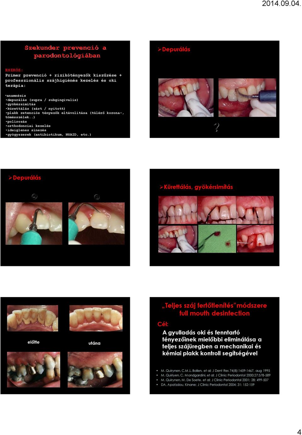 )? Depurálás Kürettálás, gyökérsimítás előtte utána Teljes száj fertőtlenítés módszere full mouth desinfection Cél: A gyulladás oki és fenntartó tényezőinek mielőbbi eliminálása a teljes szájüregben