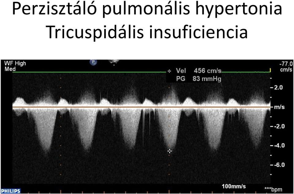 hypertonia