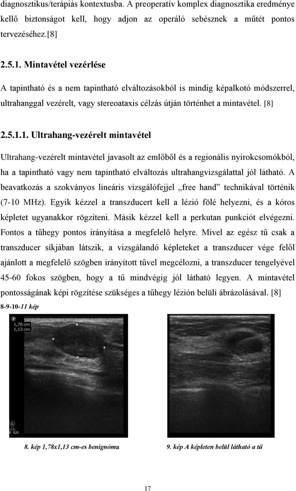 1. Ultrahang-vezérelt mintavétel Ultrahang-vezérelt mintavétel javasolt az emlőből és a regionális nyirokcsomókból, ha a tapintható vagy nem tapintható elváltozás ultrahangvizsgálattal jól látható.