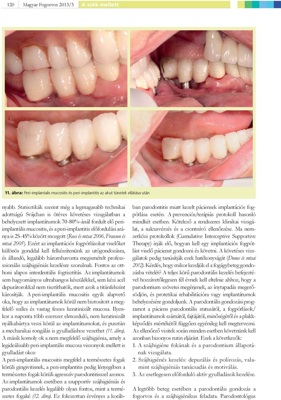 peri-implantitis előfordulási aránya is 25-45% között mozgott (Ross és mtsai 2006, Franson és mtsai 2005).