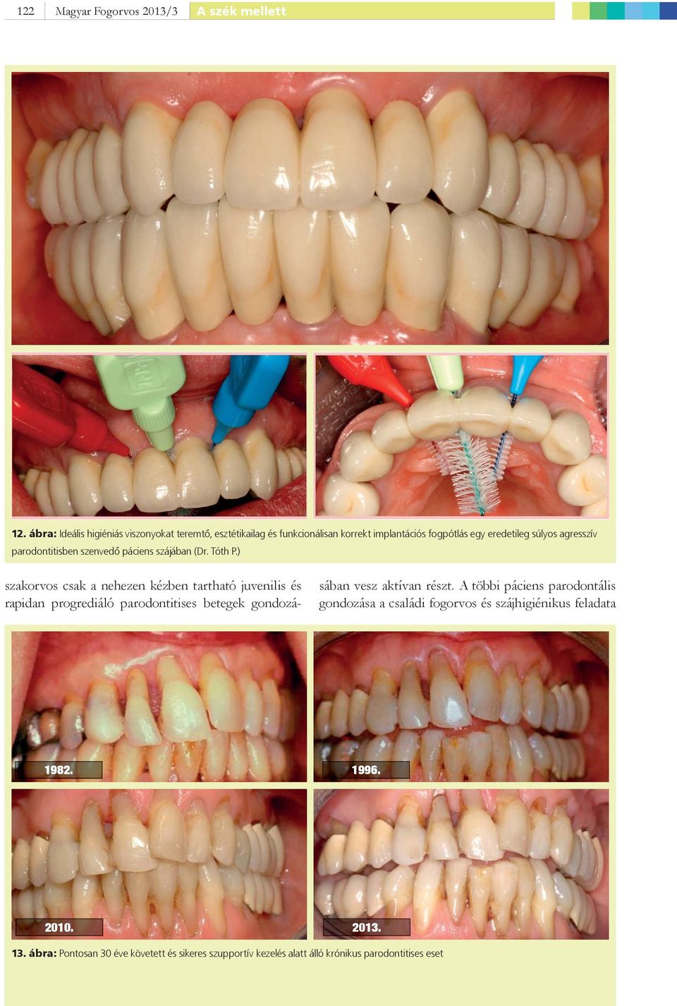 parodontitisben szenvedő páciens szájában (Dr. Tóth P.