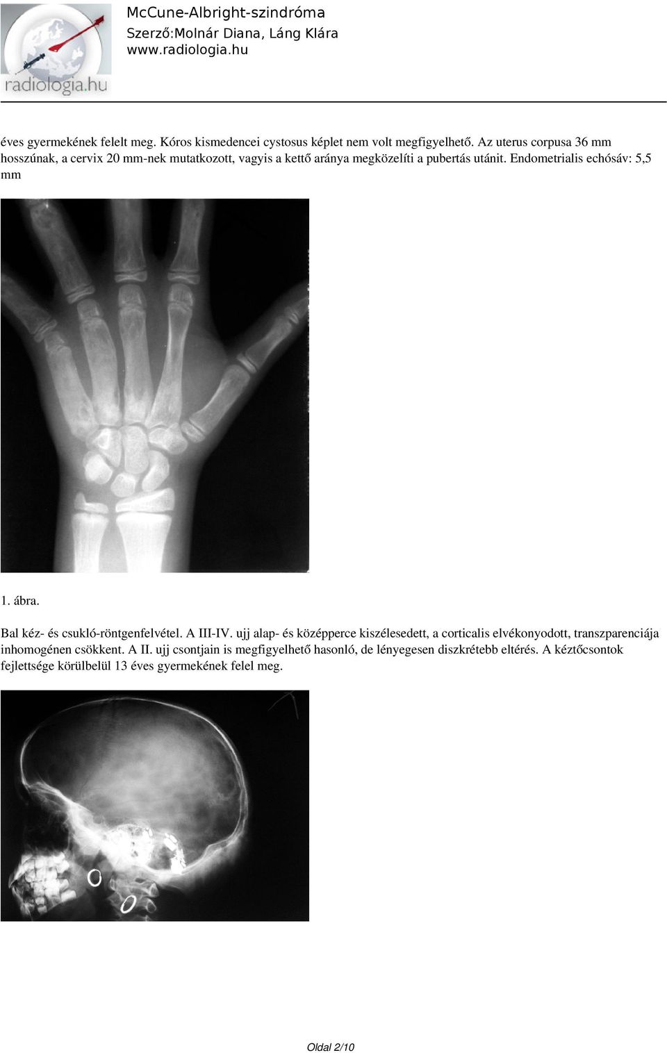 Endometrialis echósáv: 5,5 mm 1. ábra. Bal kéz- és csukló-röntgenfelvétel. A III-IV.