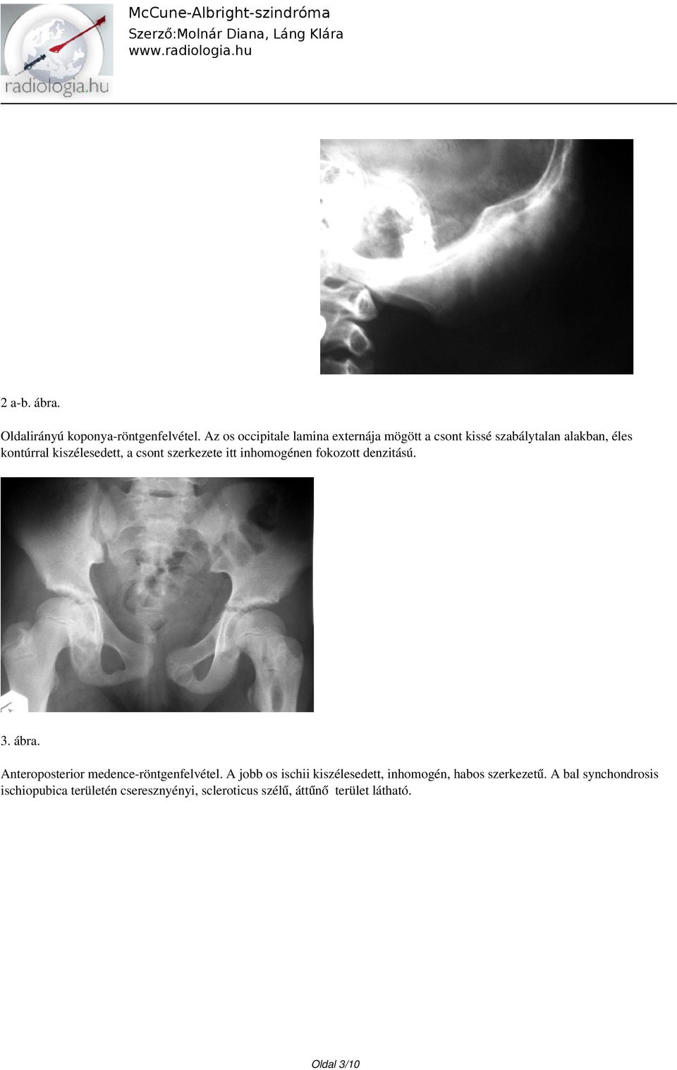 csont szerkezete itt inhomogénen fokozott denzitású. 3. ábra. Anteroposterior medence-röntgenfelvétel.