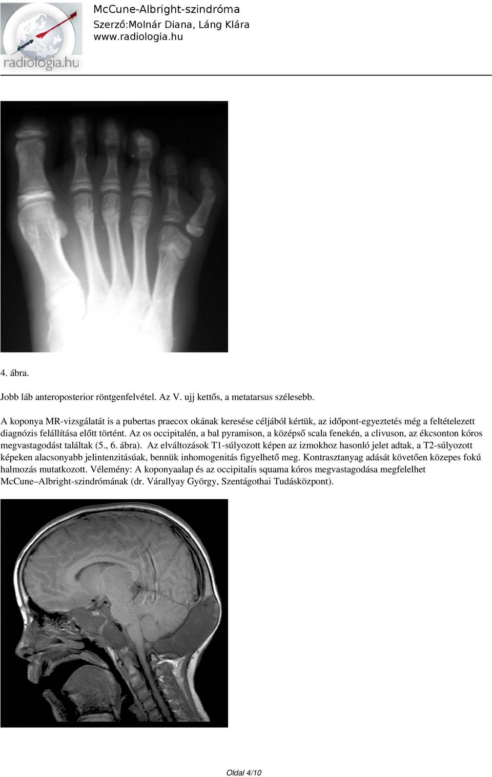 Az os occipitalén, a bal pyramison, a középső scala fenekén, a clivuson, az ékcsonton kóros megvastagodást találtak (5., 6. ábra).