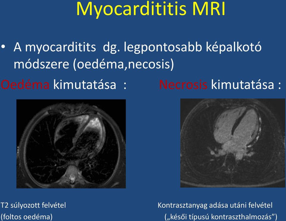 kimutatása : Necrosis kimutatása : T2 súlyozott felvétel