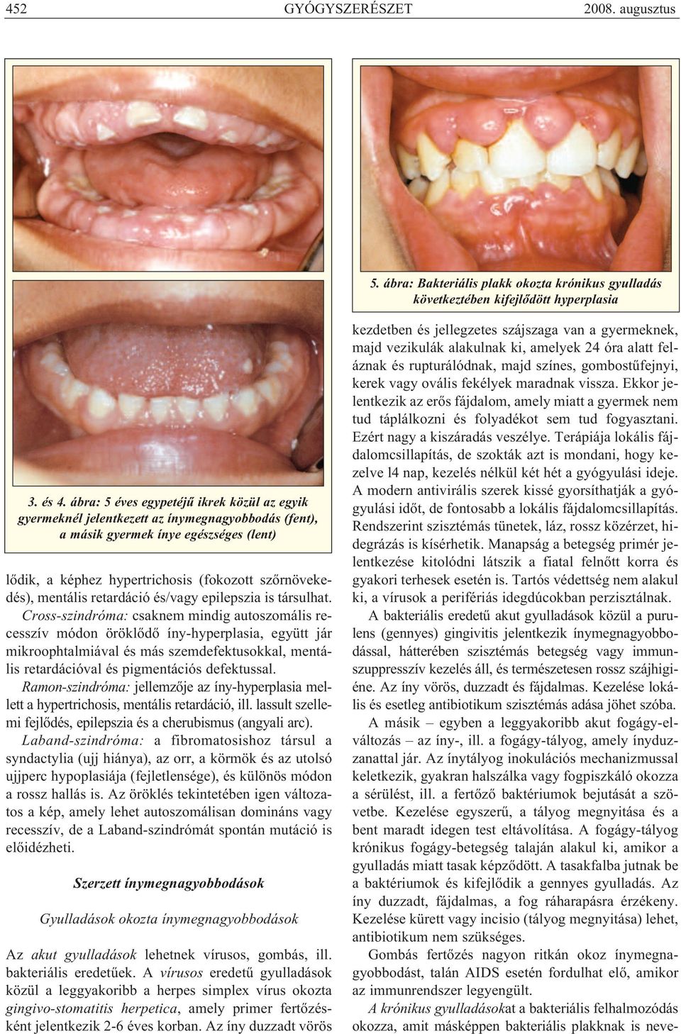 mentális retardáció és/vagy epilepszia is társulhat.