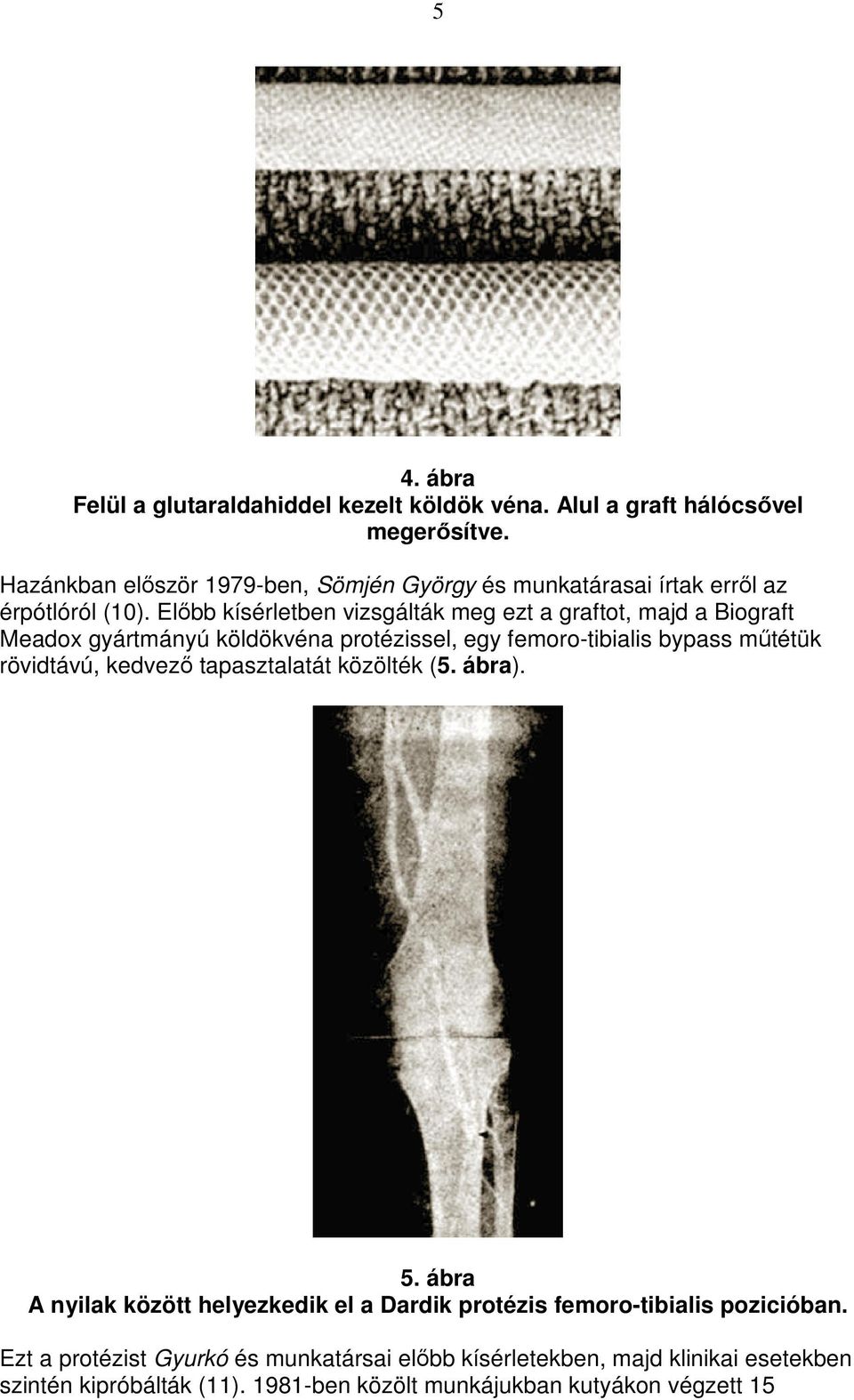 Elıbb kísérletben vizsgálták meg ezt a graftot, majd a Biograft Meadox gyártmányú köldökvéna protézissel, egy femoro-tibialis bypass mőtétük rövidtávú,