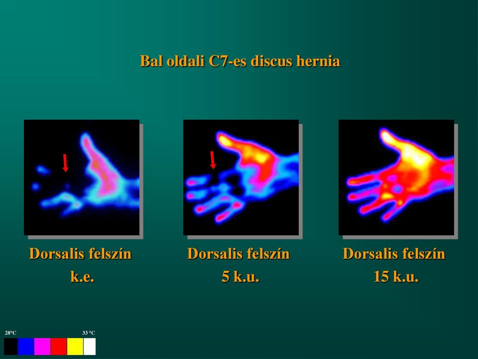 hernia k.e. 5 k.