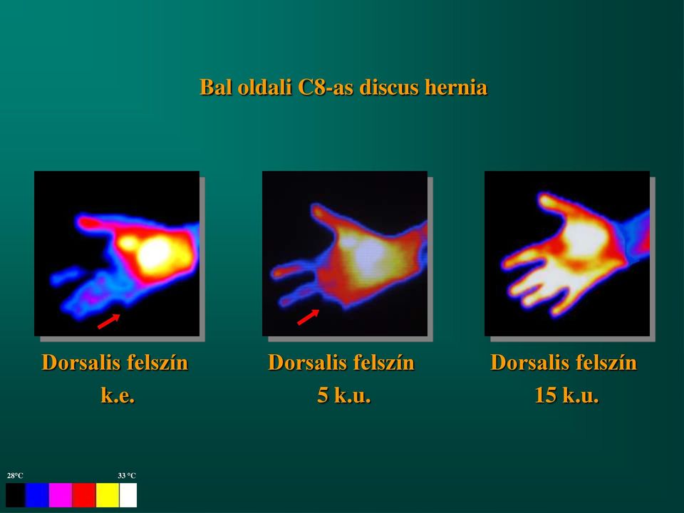 hernia k.e. 5 k.