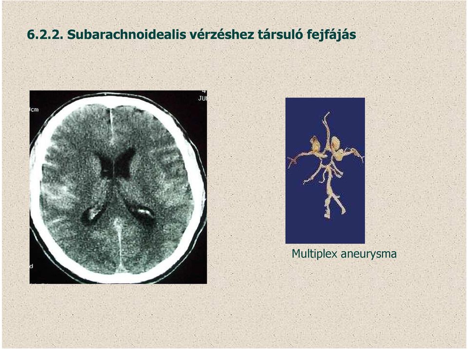 vérzéshez társuló