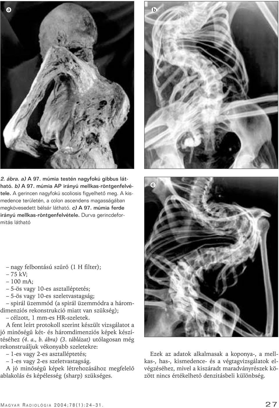 Durva gerincdeformitás látható c nagy felbontású szûrô (1 H filter); 75 kv; 100 ma; 5-ös vagy 10-es asztalléptetés; 5-ös vagy 10-es szeletvastagság; spirál üzemmód (a spirál üzemmódra a