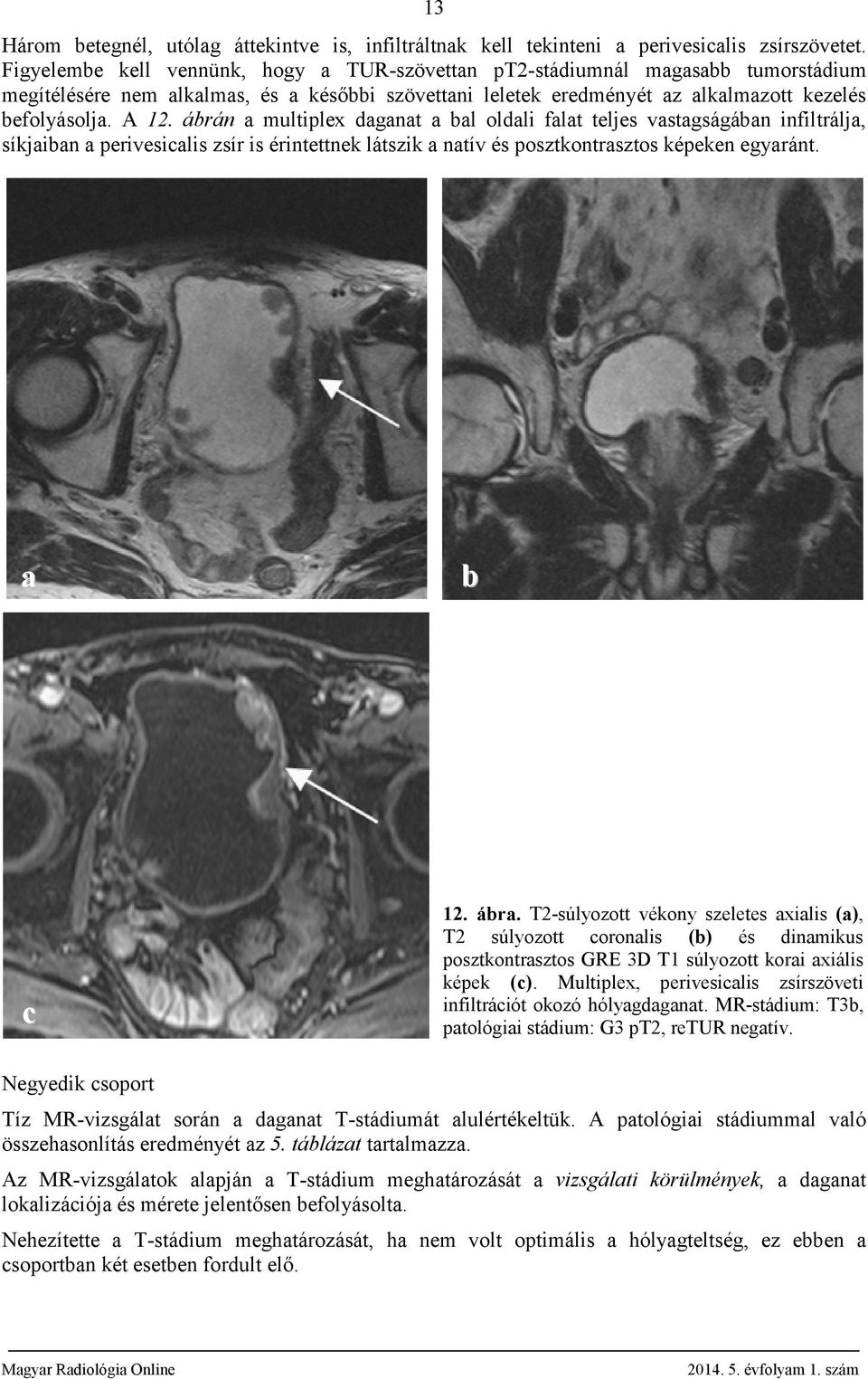 ábrán a multiplex daganat a bal oldali falat teljes vastagságában infiltrálja, síkjaiban a perivesicalis zsír is érintettnek látszik a natív és posztkontrasztos képeken egyaránt. a b c 12. ábra.