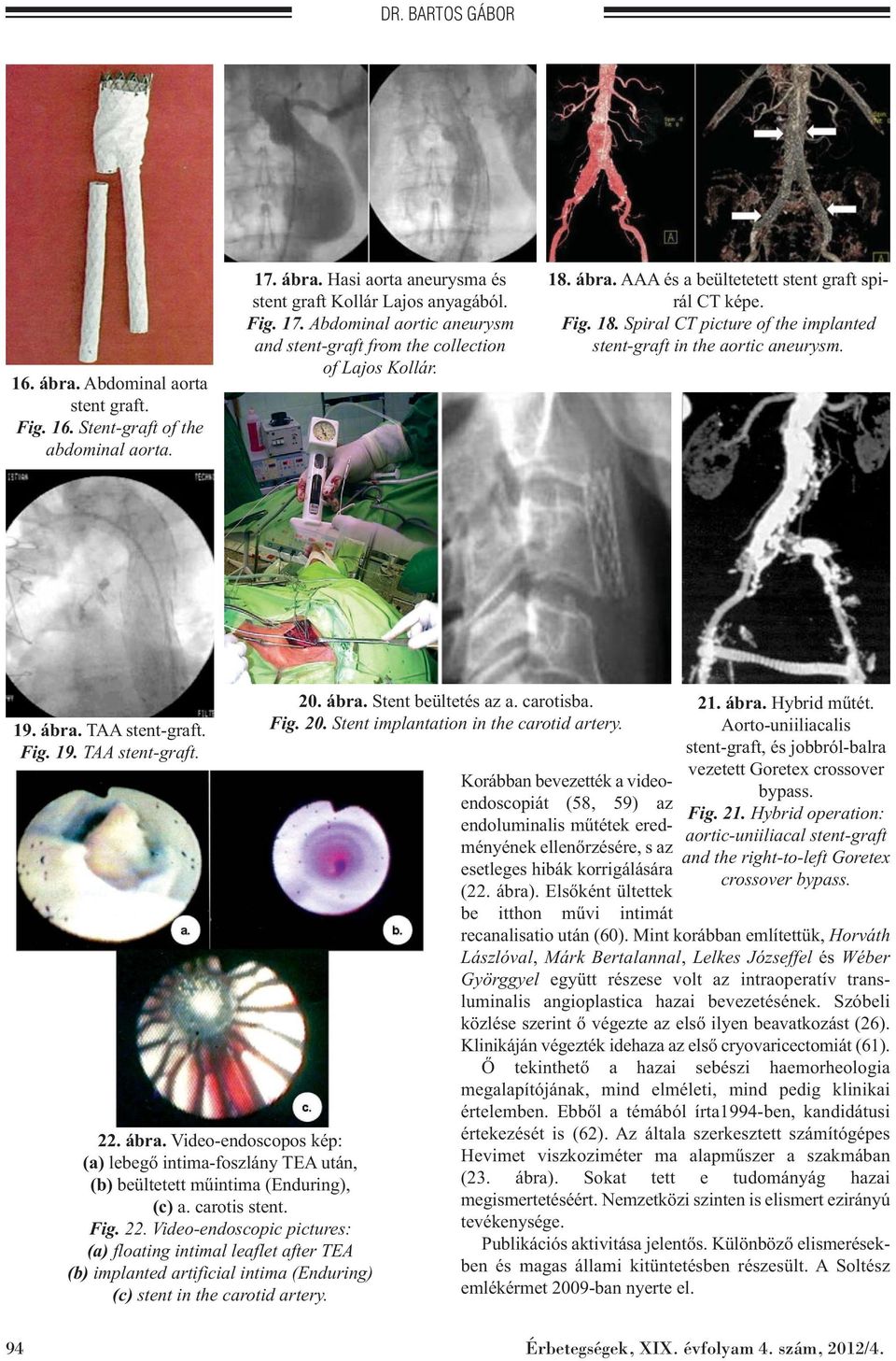 ábra. Video-endoscopos kép: (a) lebegő intima-foszlány TEA után, (b) beültetett műintima (Enduring), (c) a. carotis stent. Fig. 22.