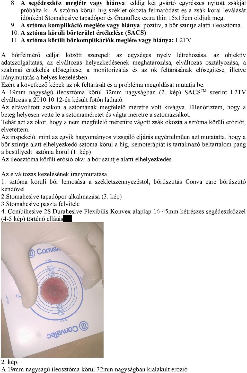 A sztóma komplikáció megléte vagy hiánya: pozitív, a bőr szintje alatti ileosztóma. 10. A sztóma körüli bőrterület értékelése (SACS): 11.