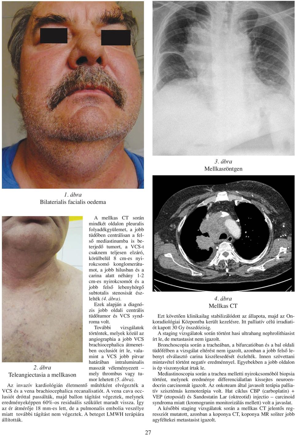 körülbelül 8 cm-es nyirokcsomó konglomerátumot, a jobb hilusban és a carina alatt néhány 1-2 cm-es nyirokcsomót és a jobb felsô lebenyhörgô subtotalis stenosisát észlelték (4. ábra).