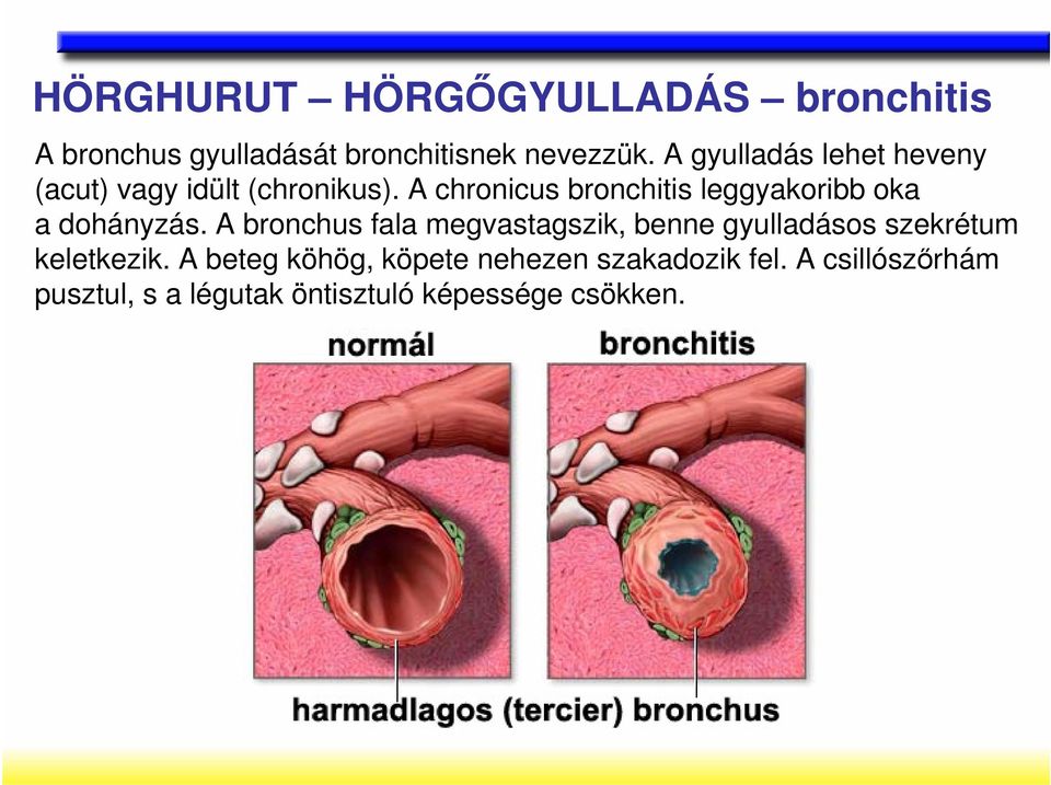 A chronicus bronchitis leggyakoribb oka a dohányzás.