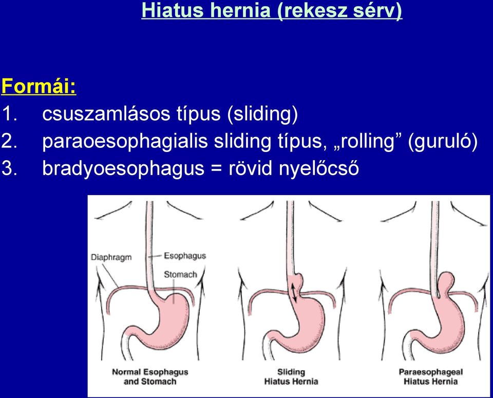 paraoesophagialis sliding típus,