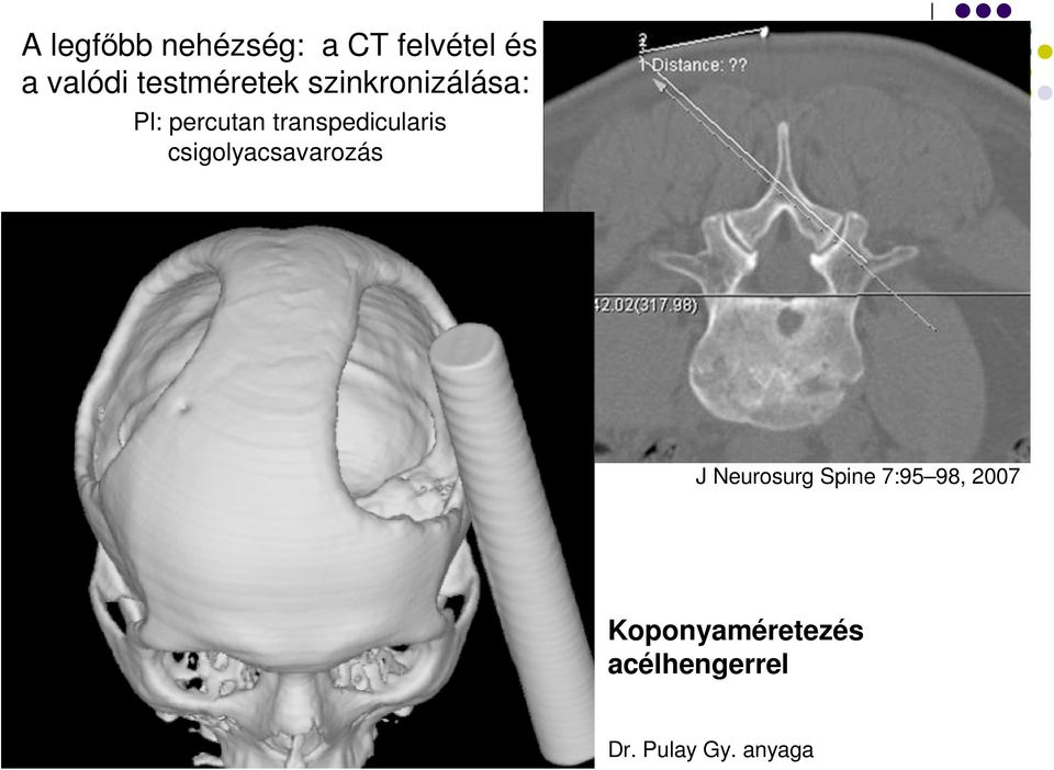 transpedicularis csigolyacsavarozás J Neurosurg