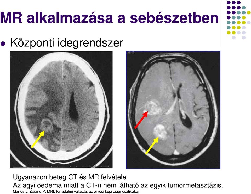 Az agyi oedema miatt a CT-n nem látható az egyik