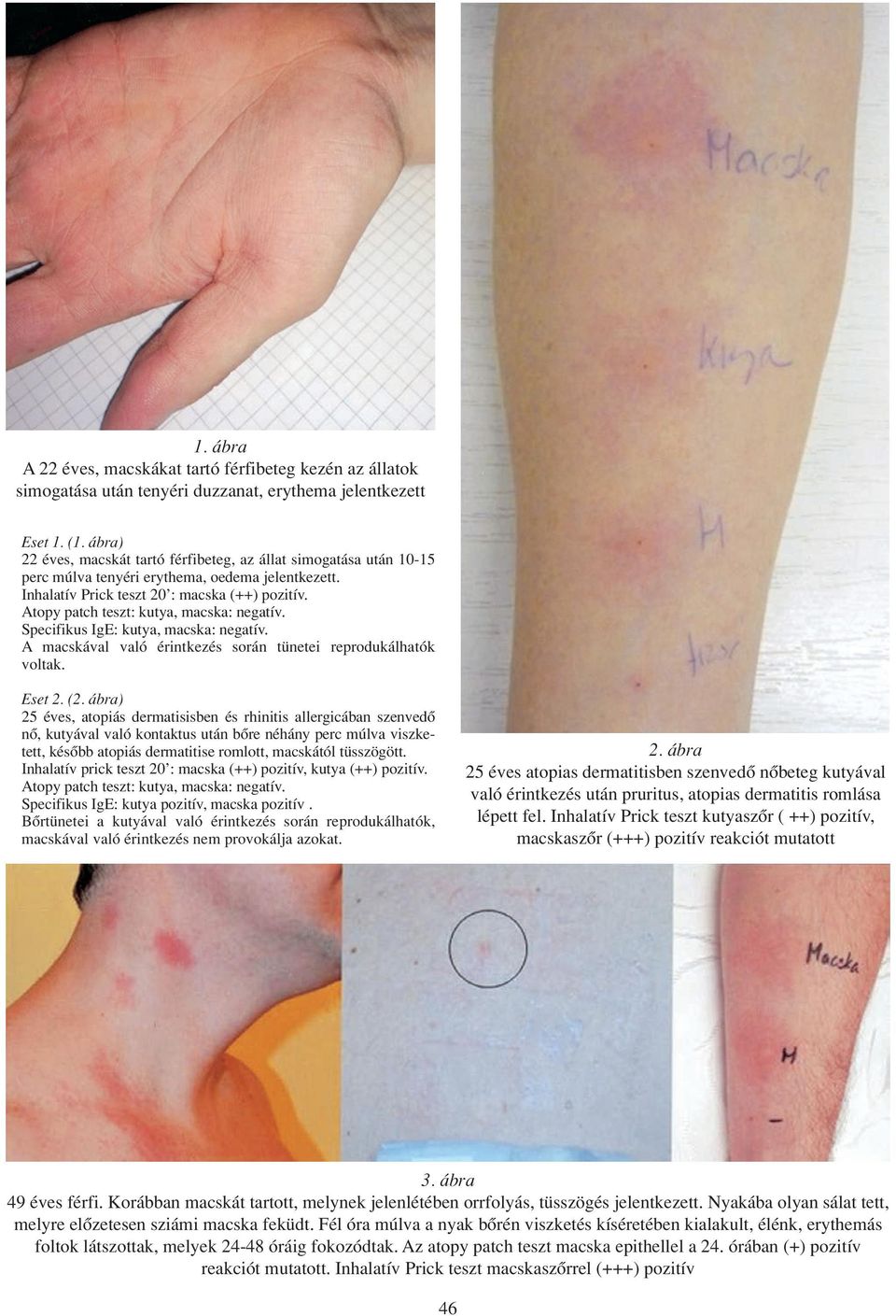 Atopy patch teszt: kutya, macska: negatív. Specifikus IgE: kutya, macska: negatív. A macskával való érintkezés során tünetei reprodukálhatók voltak. Eset 2. (2.