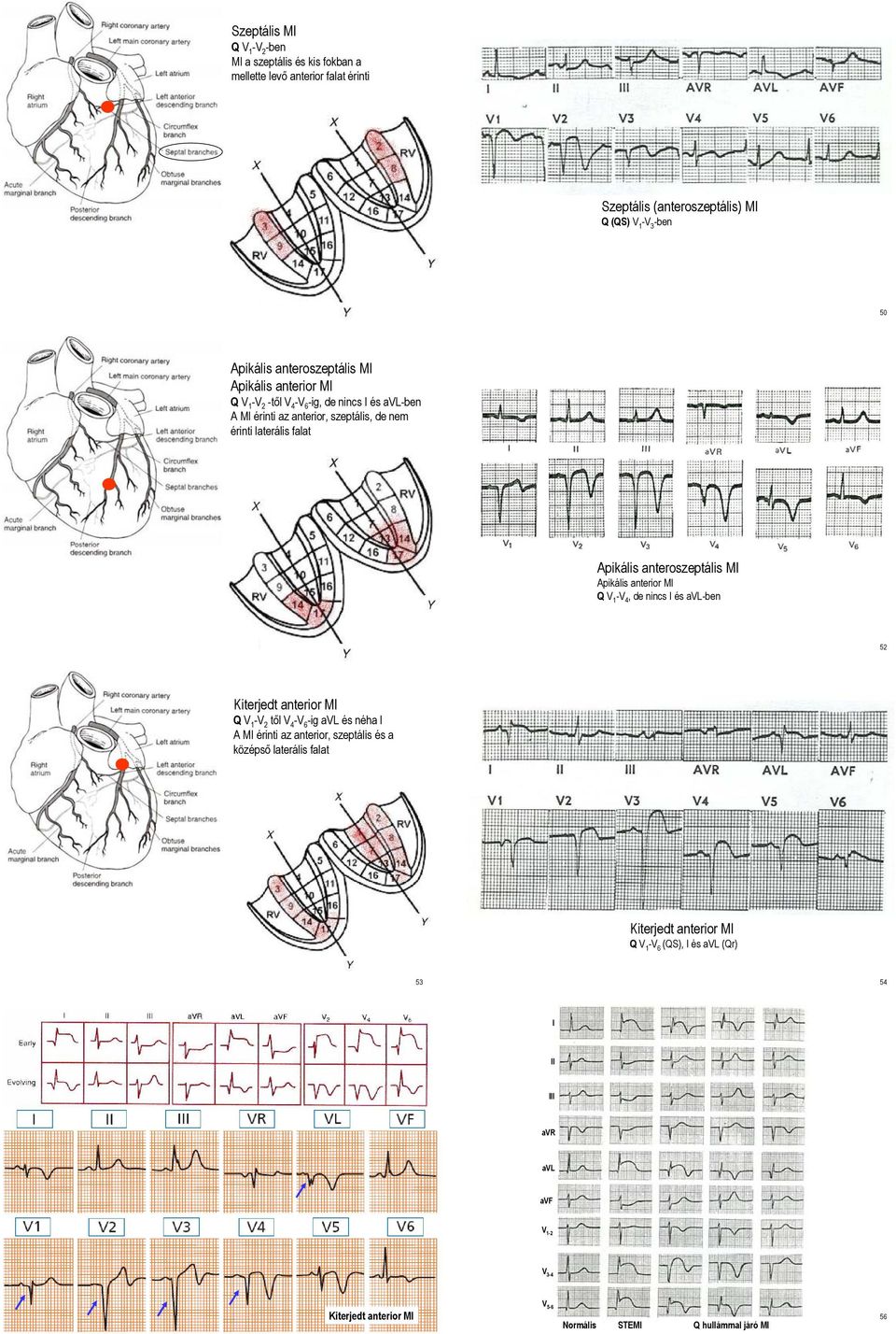 Apikális anterior MI Q V 1 -V 4, de nincs I és avl-ben 51 52 Kiterjedt anterior MI Q V 1 -V 2 től V 4 -V 6 -ig avl és néha I A MI érinti az anterior, szeptális és a