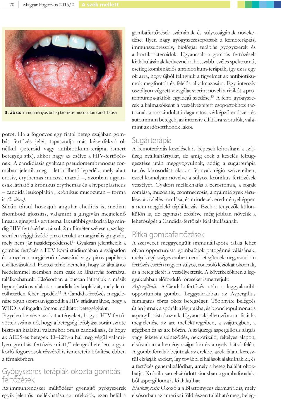 A candidiasis gyakran pseudomembranosus formában jelenik meg letörölhető lepedék, mely alatt erosiv, erythemas mucosa marad, azonban ugyancsak látható a krónikus erythemas és a hyperplasticus candida