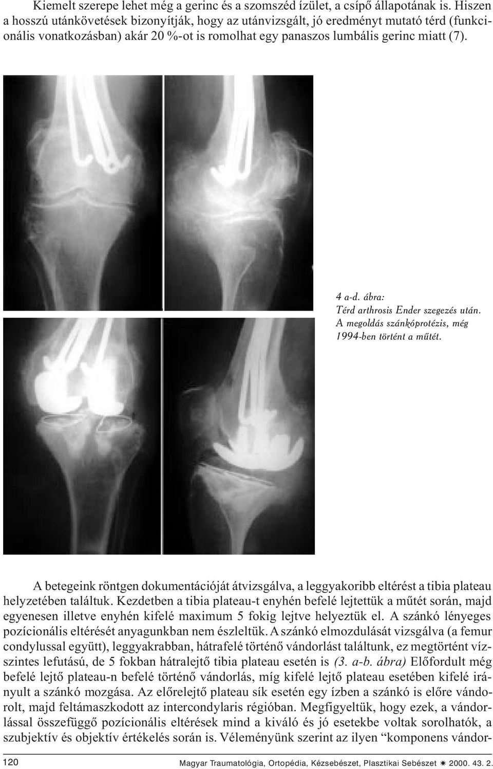 ábra: Térd arthrosis Ender szegezés után. A megoldás szánkóprotézis, még 1994-ben történt a mûtét.