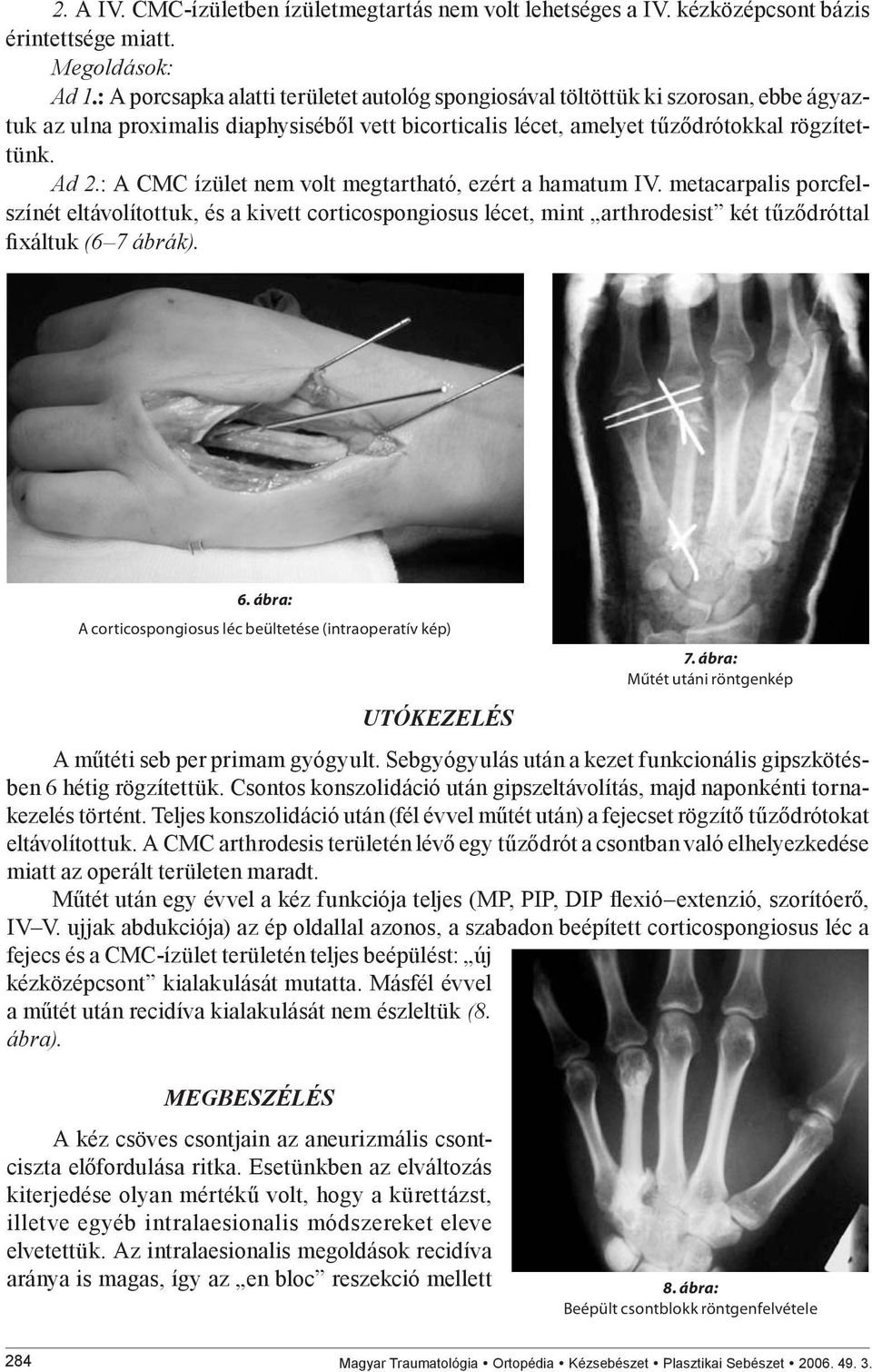 : A CMC ízület nem volt megtartható, ezért a hamatum IV. metacarpalis porcfelszínét eltávolítottuk, és a kivett corticospongiosus lécet, mint arthrodesist két tűződróttal fixáltuk (6 7 ábrák). 6.