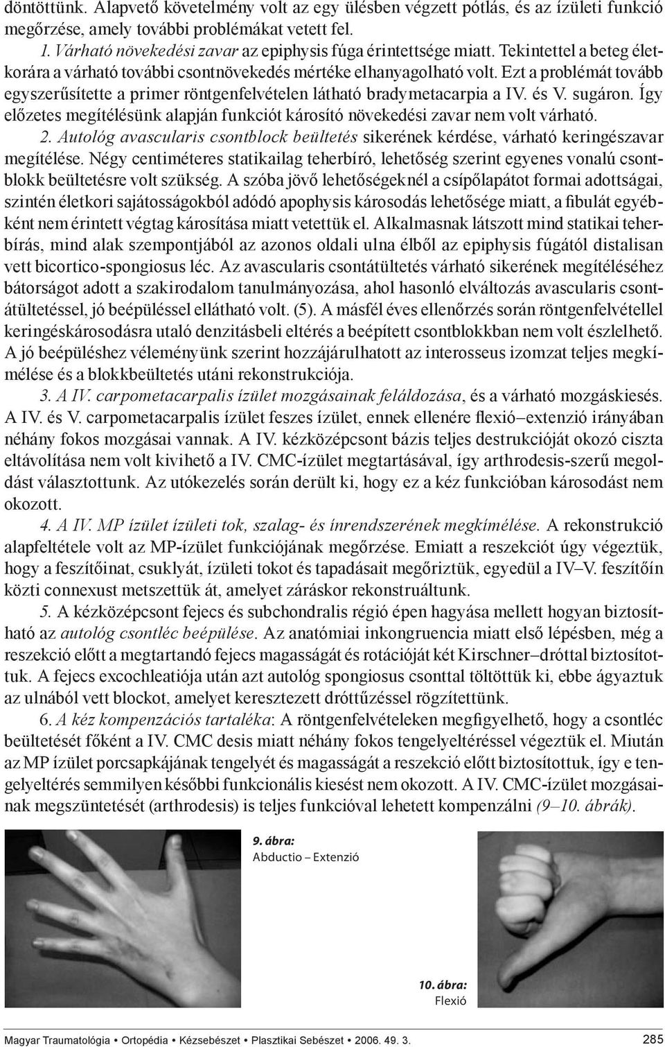 Ezt a problémát tovább egyszerűsítette a primer röntgenfelvételen látható bradymetacarpia a IV. és V. sugáron. Így előzetes megítélésünk alapján funkciót károsító növekedési zavar nem volt várható. 2.