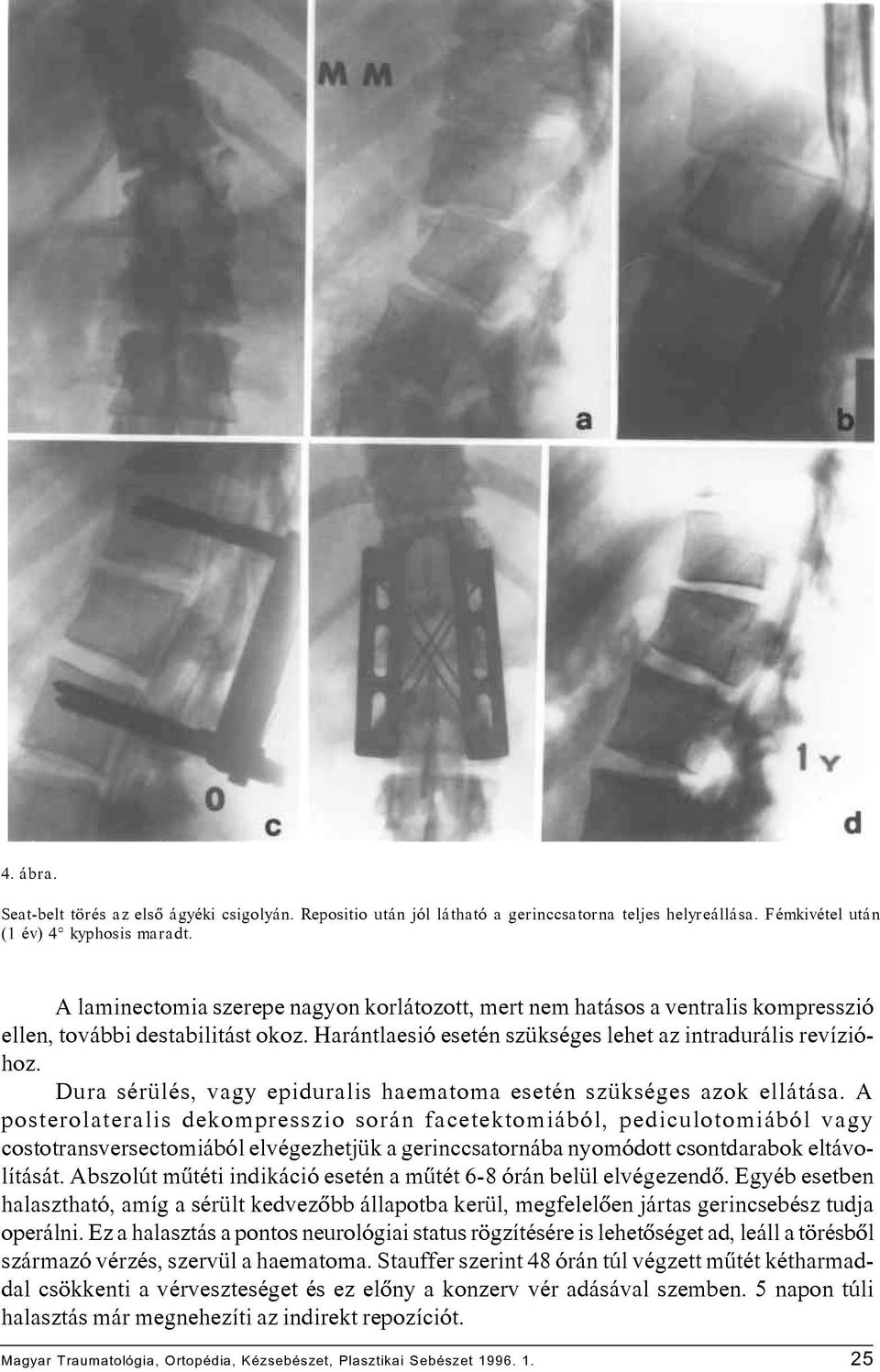 Dura sérülés, vagy epiduralis haematoma esetén szükséges azok ellátása.