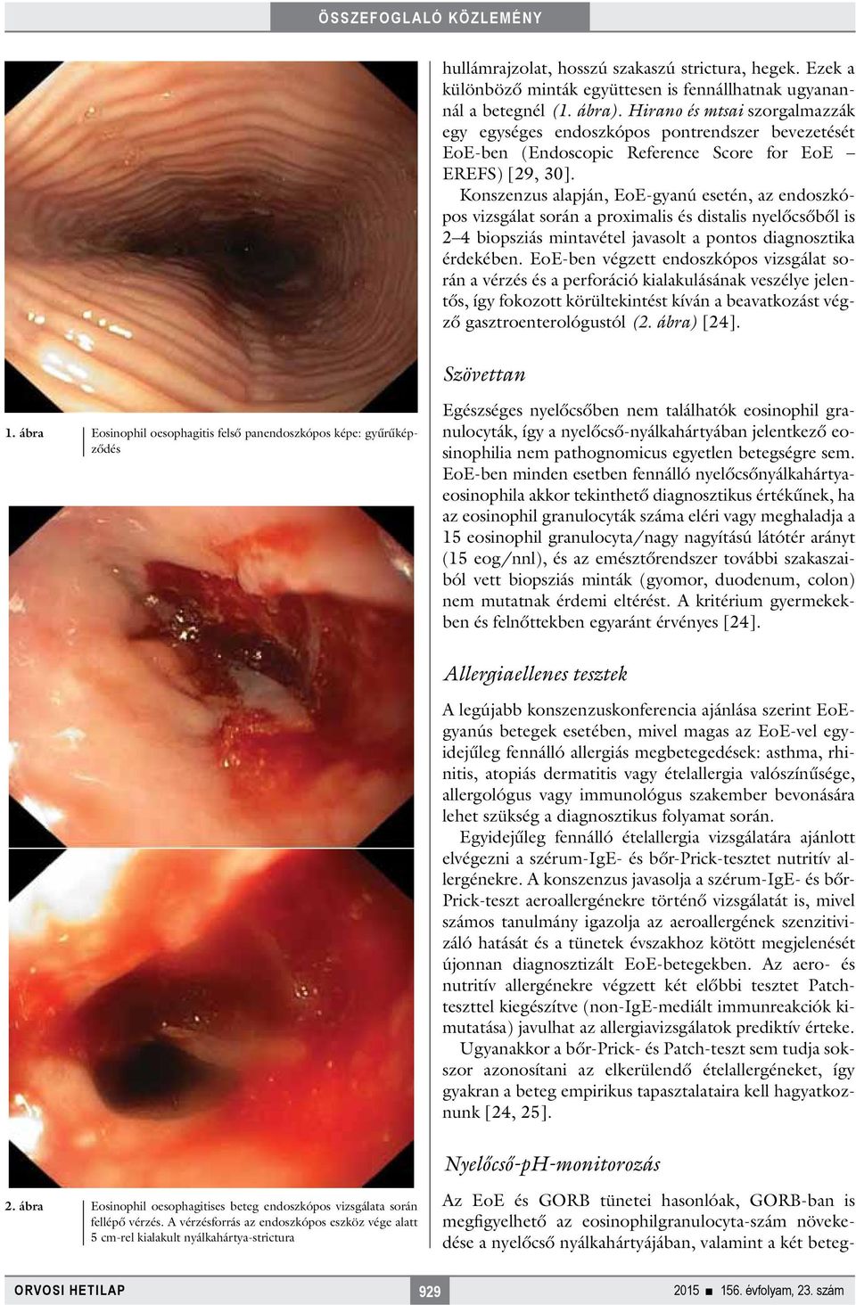 Konszenzus alapján, EoE-gyanú esetén, az endoszkópos vizsgálat során a proximalis és distalis nyelőcsőből is 2 4 biopsziás mintavétel javasolt a pontos diagnosztika érdekében.