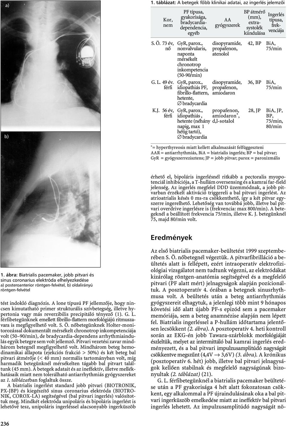 , idiopathiás PF, fibrillo-flattern, hetente, bradycardia AA gyógyszerek disopyramide, propafenon, atenolol disopyramide, propafenon, amiodaron GyR, parox.