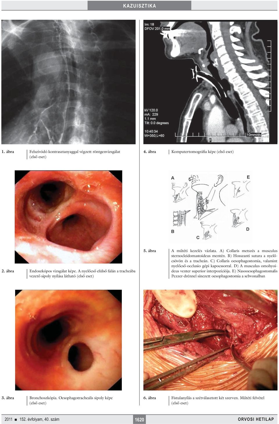 B) Hosszanti sutura a nyelőcsövön és a tracheán. C) Collaris oesophagostomia, valamint nyelőcső-occlusio gépi kapocssorral.