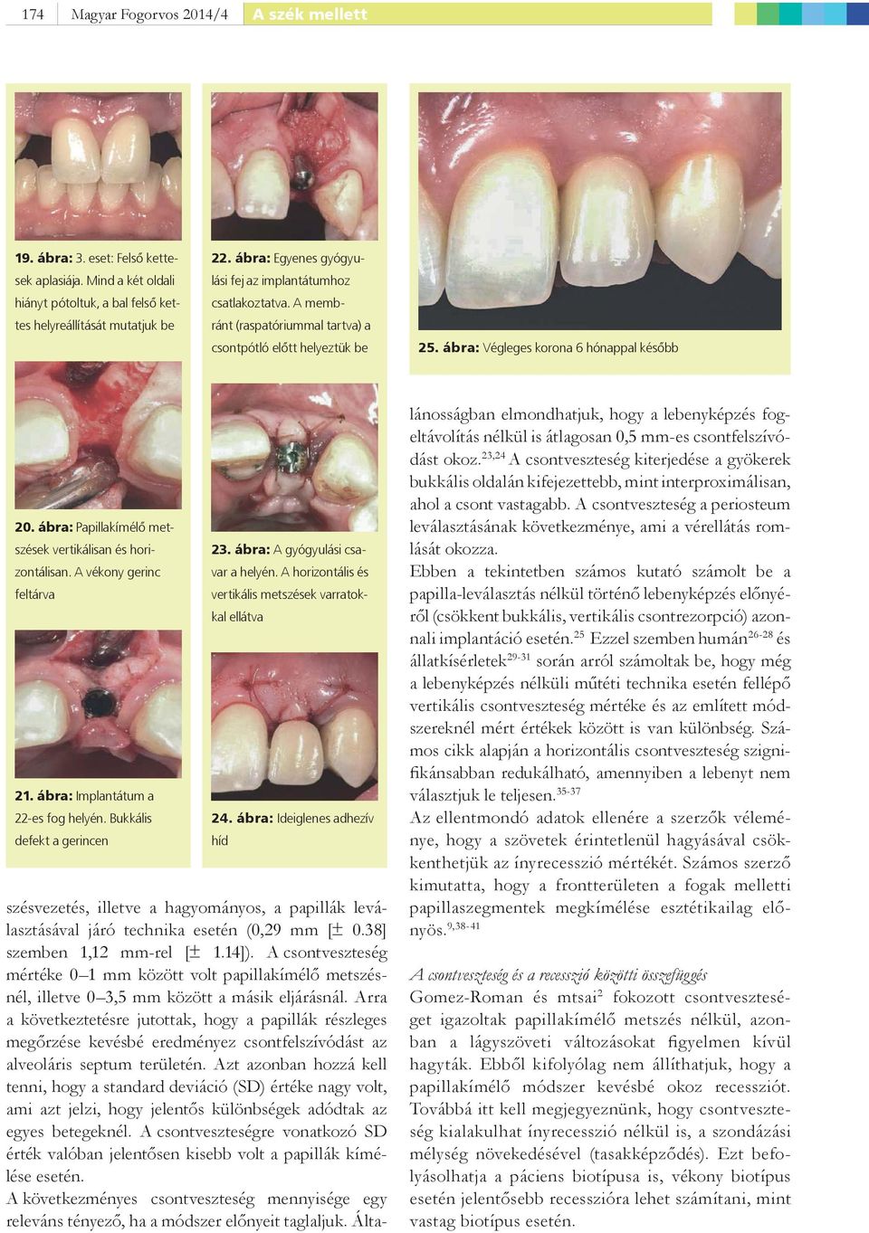 ábra: Papillakímélő metszések vertikálisan és horizontálisan. A vékony gerinc feltárva 21. ábra: Implantátum a 22-es fog helyén. Bukkális defekt a gerincen 23. ábra: A gyógyulási csavar a helyén.