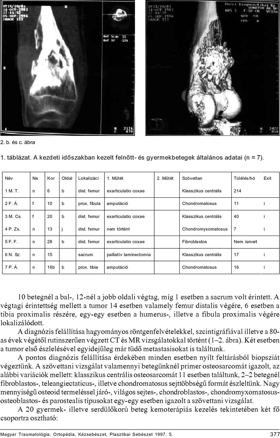 n 13 j dist. femur nem történt Chondromyxomatosus 7 i 5 F. F. n 28 b dist. femur exarticulatio coxae Fibroblastos Nem ismert 6 N. Sz. n 15 sacrum palliatív laminectomia Klasszikus centrális 17 i 7 P.