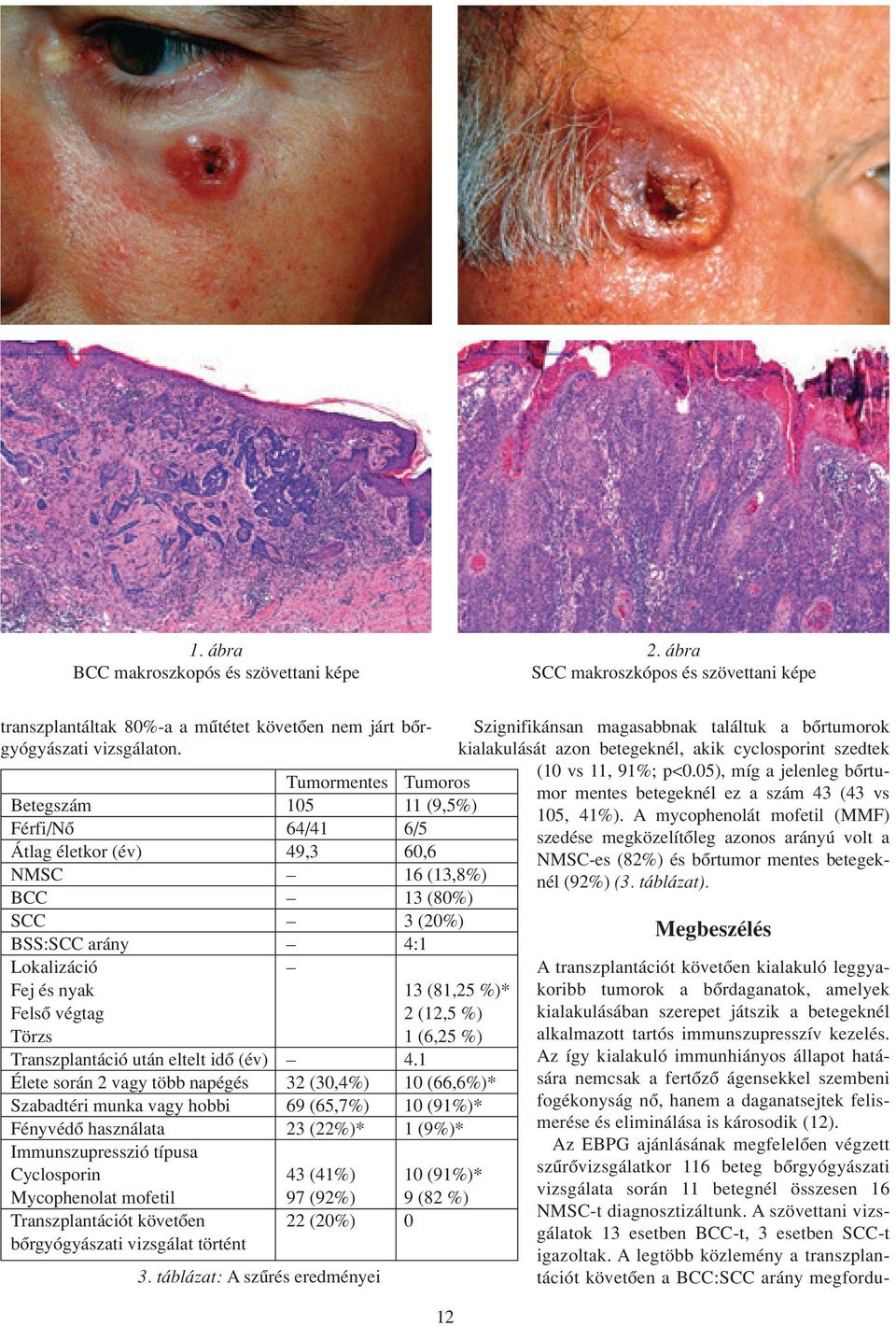 végtag 2 (12,5 %) Törzs 1 (6,25 %) Transzplantáció után eltelt idô (év) 4.
